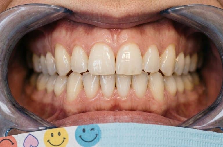 Signs Your Dental Bridge Needs Repair or Replacement